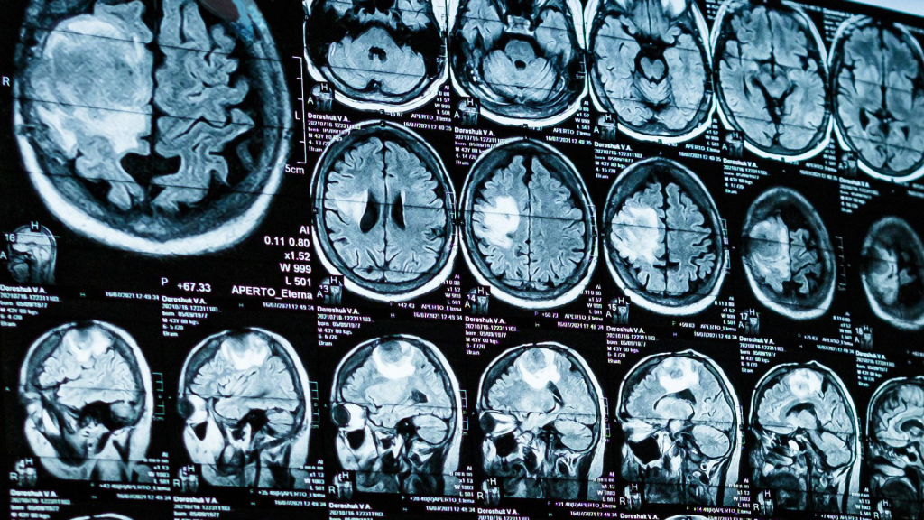 Hidden Brain Signal - Alzheimer