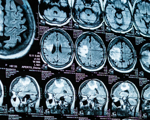 Hidden Brain Signal - Alzheimer
